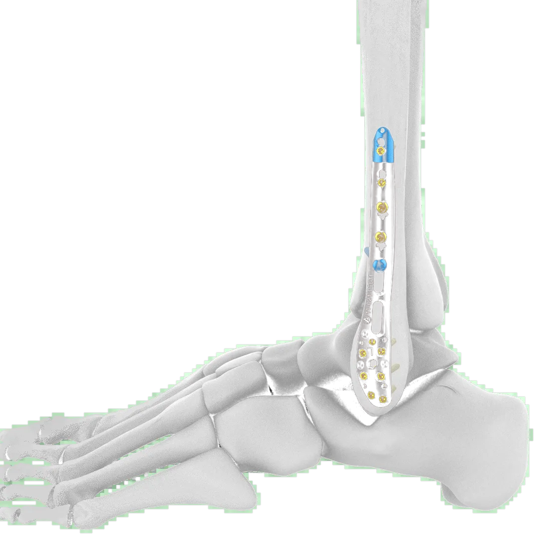 Lateral Distal Fibula Plate