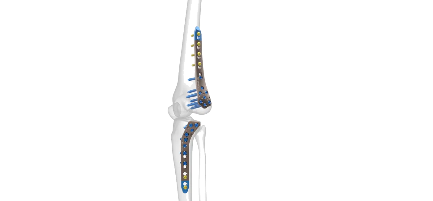 Anteromedial Distal Tibia Plate