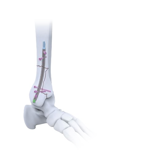 OsteoDrive Motorizado