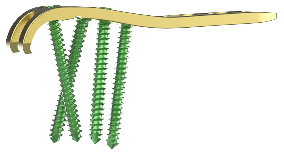 Proximal Ulna Plate