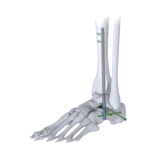 Ankle Arthrodesis Nail