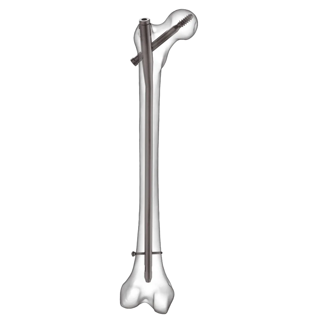 Athos® Nailing System (Hip/Femur)